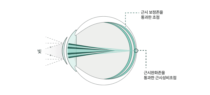 시야 단면